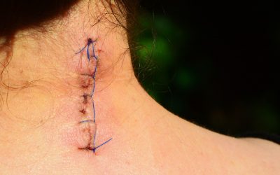Cicatrización de diferentes Tejidos con Fisioterapia